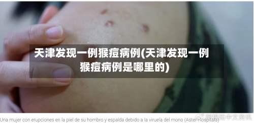 天津发现一例猴痘病例(天津发现一例猴痘病例是哪里的)-第2张图片